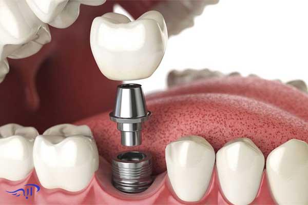 روشهای جلوگیری از پوسیدگی دندان