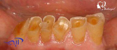 جرم‌ گیری دندان چیست و چگونه انجام می‌شود؟